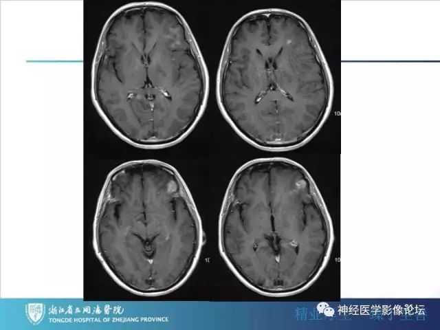 【病例】左额叶