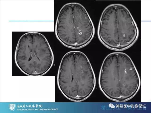 【病例】左额叶