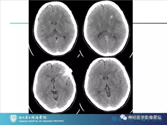 【病例】左额叶