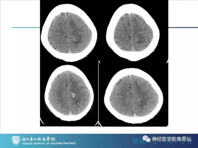 【病例】左额叶