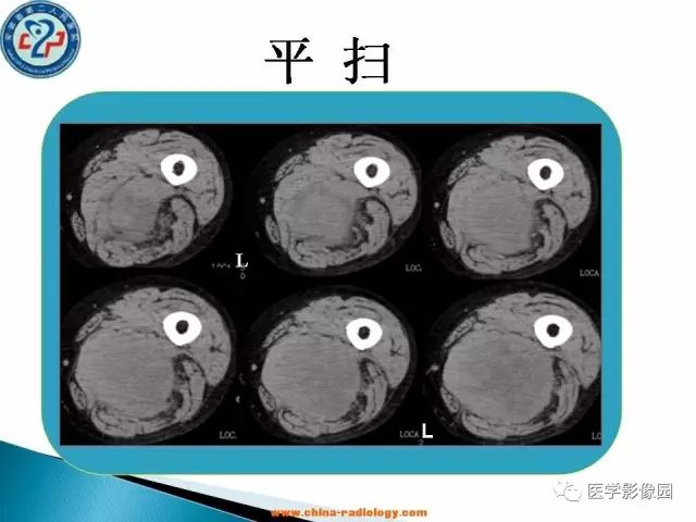 【病例】大腿恶性纤维组织细胞瘤1例CT