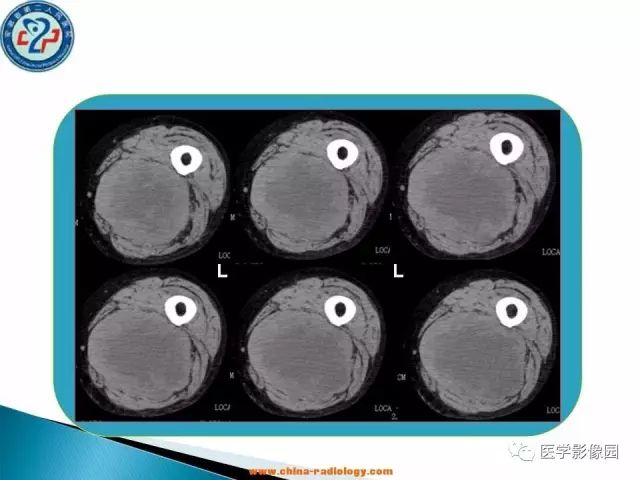 【病例】大腿恶性纤维组织细胞瘤1例CT