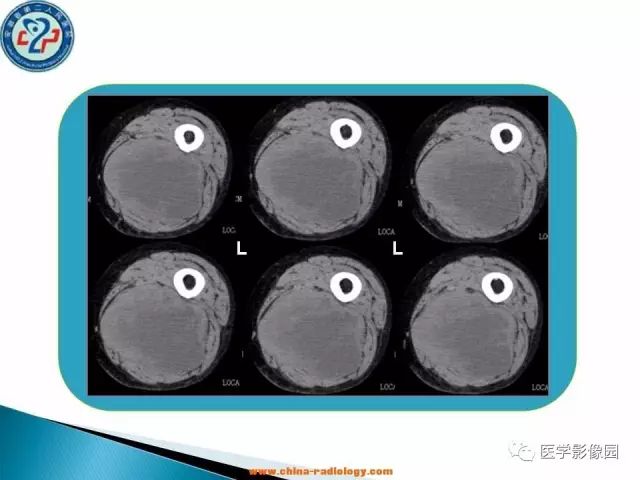 【病例】大腿恶性纤维组织细胞瘤1例CT