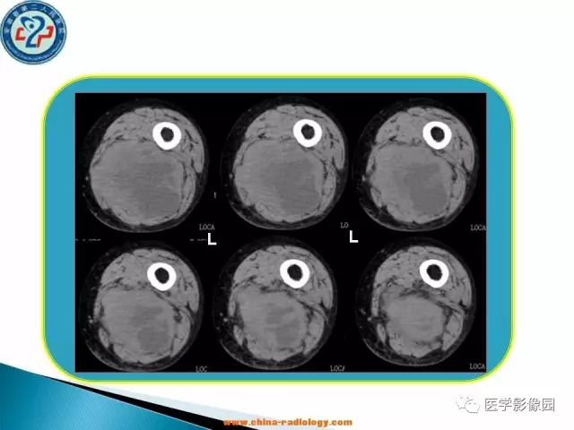【病例】大腿恶性纤维组织细胞瘤1例CT