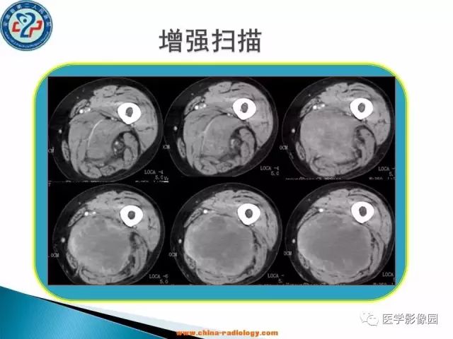 【病例】大腿恶性纤维组织细胞瘤1例CT