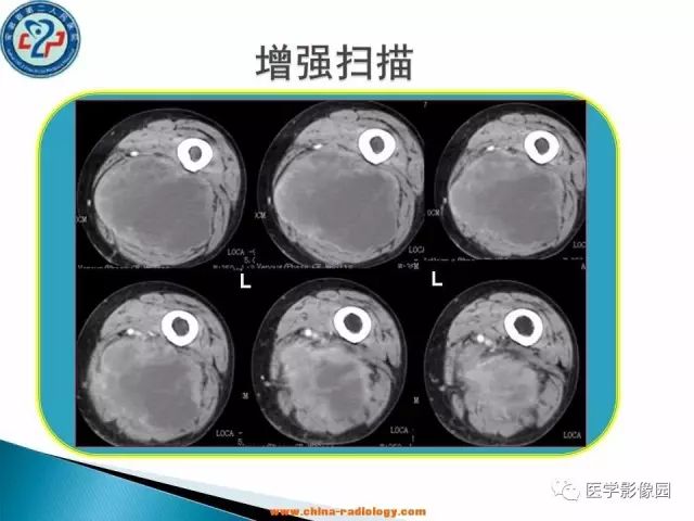 【病例】大腿恶性纤维组织细胞瘤1例CT