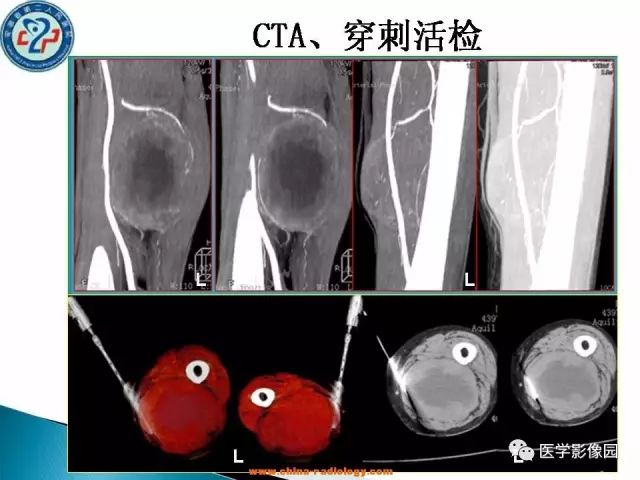 【病例】大腿恶性纤维组织细胞瘤1例CT