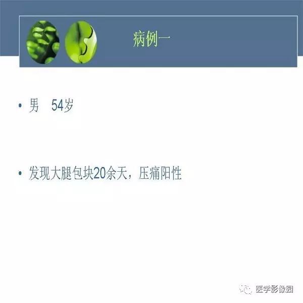【病例】右大腿滑膜肉瘤1例CT及MR