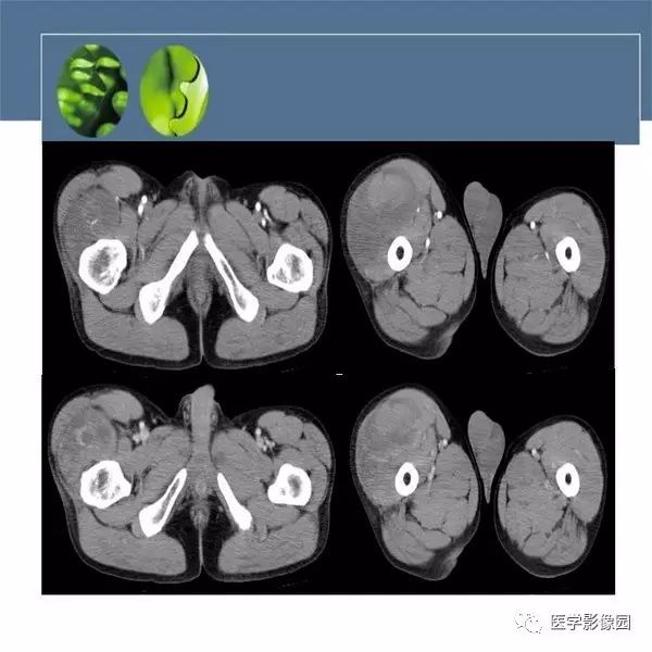 【病例】右大腿滑膜肉瘤1例CT及MR