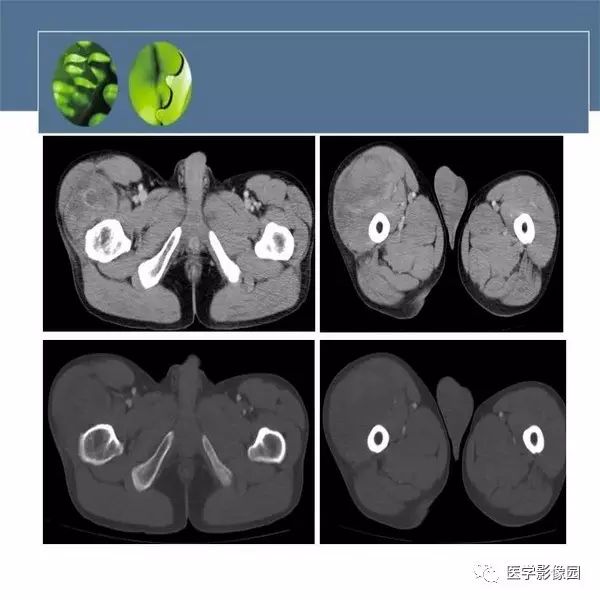 【病例】右大腿滑膜肉瘤1例CT及MR