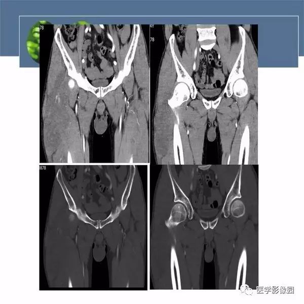 【病例】右大腿滑膜肉瘤1例CT及MR