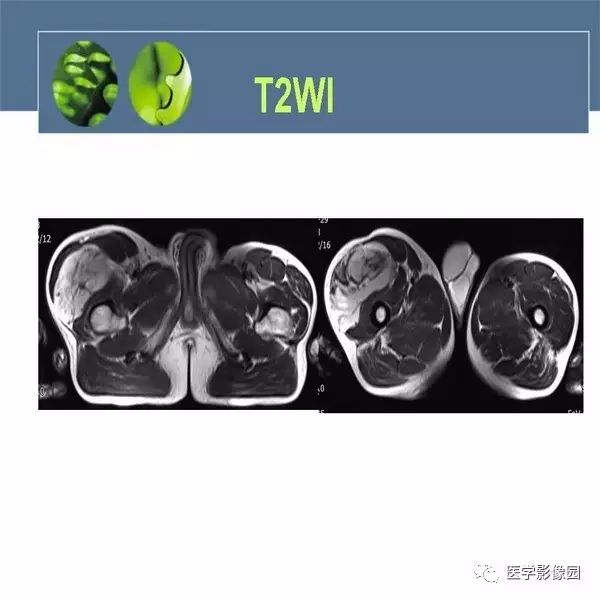 【病例】右大腿滑膜肉瘤1例CT及MR