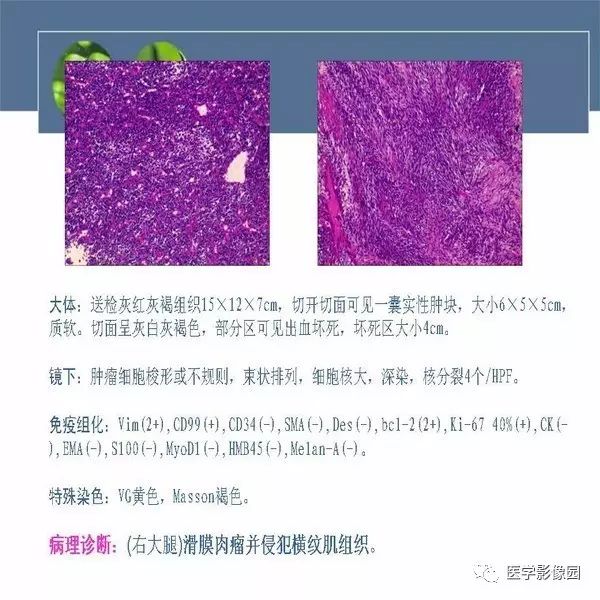 【病例】右大腿滑膜肉瘤1例CT及MR