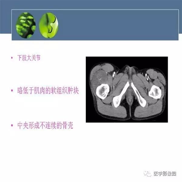 【病例】右大腿滑膜肉瘤1例CT及MR