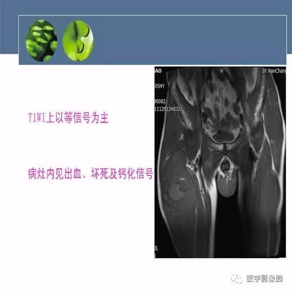 【病例】右大腿滑膜肉瘤1例CT及MR