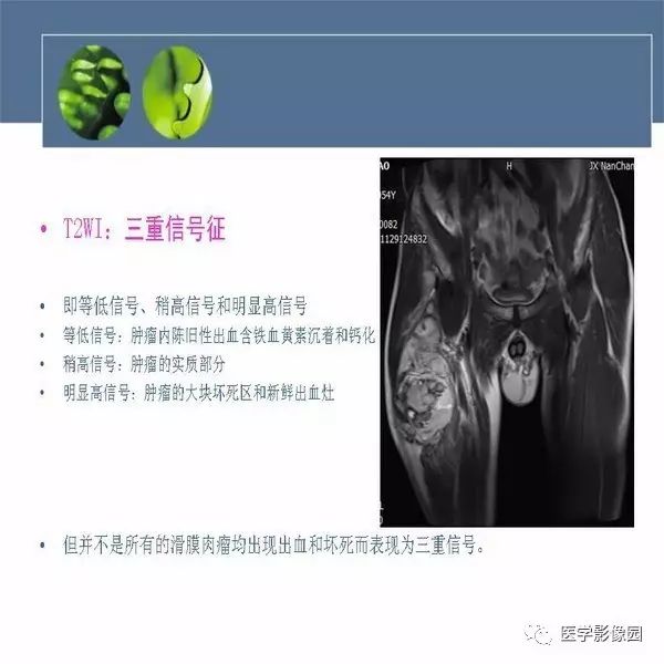 【病例】右大腿滑膜肉瘤1例CT及MR