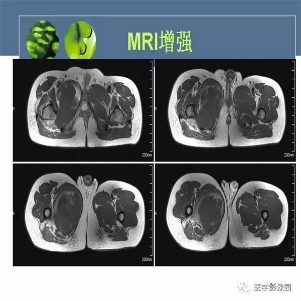 【病例】右侧大腿骨旁尤文氏肉瘤1例CT及MR