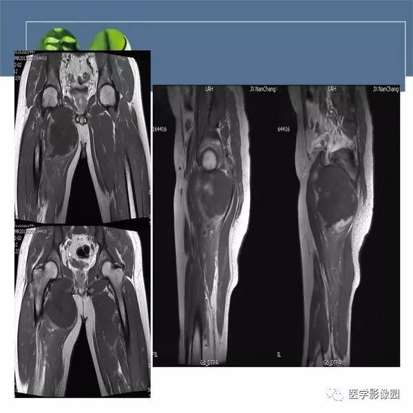 【病例】右侧大腿骨旁尤文氏肉瘤1例CT及MR