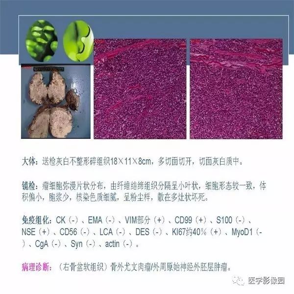 【病例】右侧大腿骨旁尤文氏肉瘤1例CT及MR