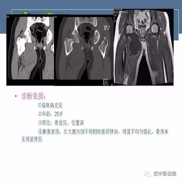 【病例】右侧大腿骨旁尤文氏肉瘤1例CT及MR