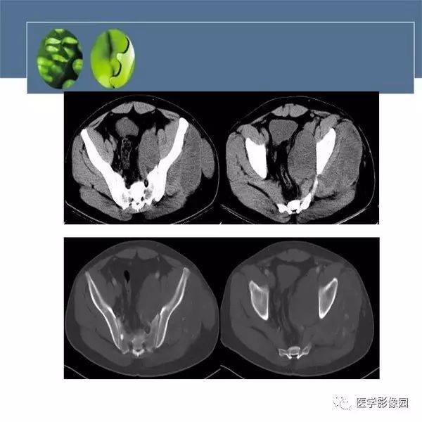 【病例】骨盆左侧恶性神经鞘瘤1例CT及MR