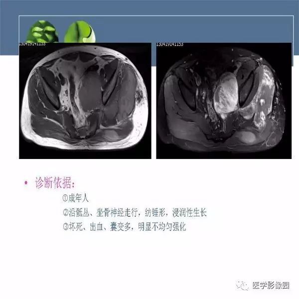 【病例】骨盆左侧恶性神经鞘瘤1例CT及MR