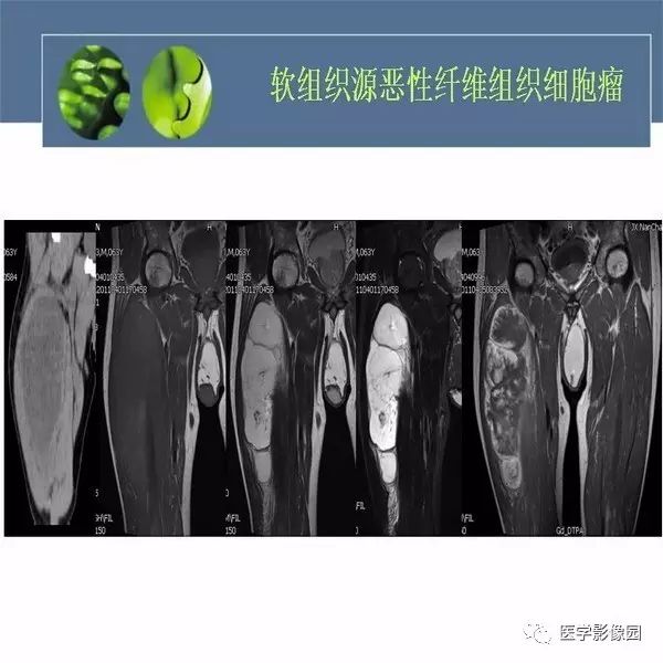 【病例】骨盆左侧恶性神经鞘瘤1例CT及MR