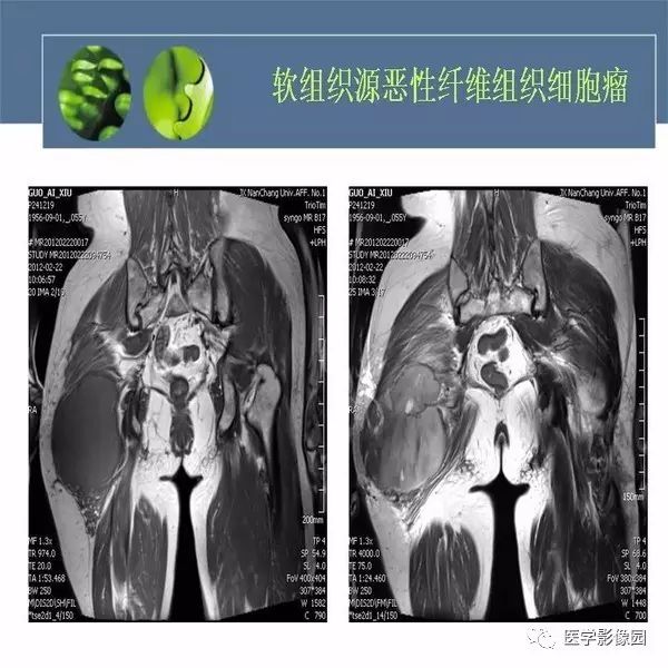 【病例】骨盆左侧恶性神经鞘瘤1例CT及MR