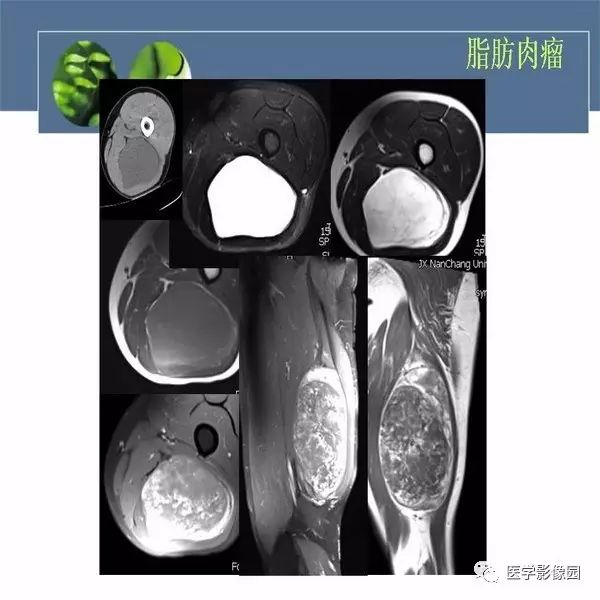 【病例】骨盆左侧恶性神经鞘瘤1例CT及MR