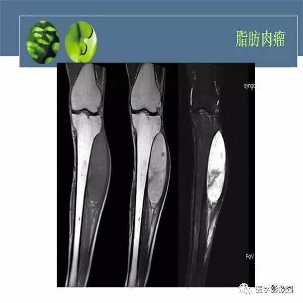 【病例】骨盆左侧恶性神经鞘瘤1例CT及MR