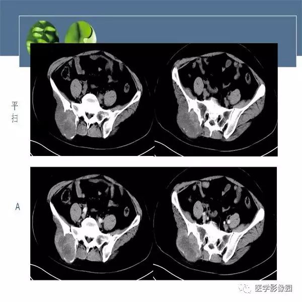 【病例】右侧髂骨恶性纤维组织细胞瘤1例CT及MR