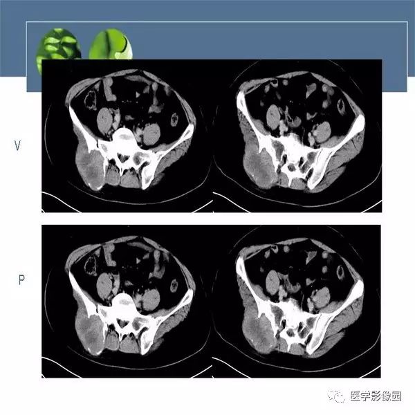 【病例】右侧髂骨恶性纤维组织细胞瘤1例CT及MR