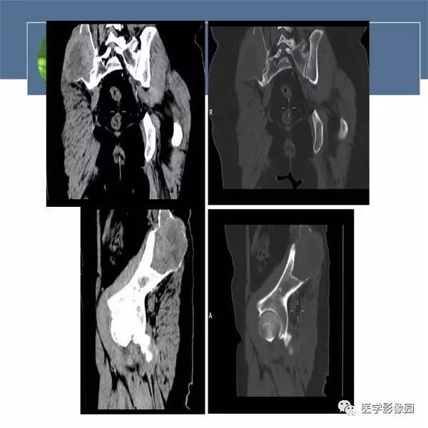 【病例】右侧髂骨恶性纤维组织细胞瘤1例CT及MR