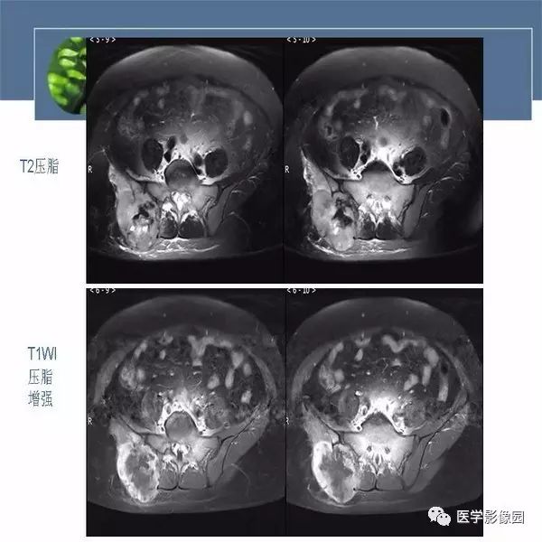 【病例】右侧髂骨恶性纤维组织细胞瘤1例CT及MR