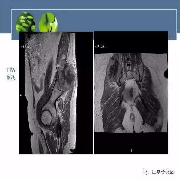 【病例】右侧髂骨恶性纤维组织细胞瘤1例CT及MR