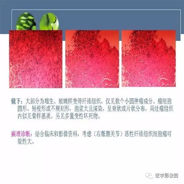 【病例】右侧髂骨恶性纤维组织细胞瘤1例CT及MR