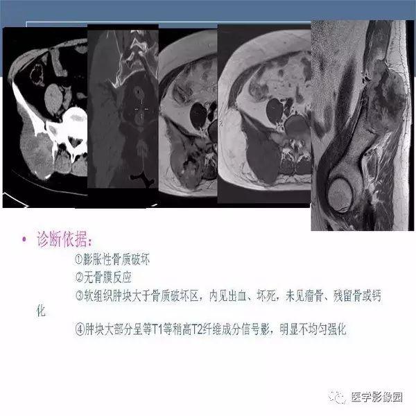 【病例】右侧髂骨恶性纤维组织细胞瘤1例CT及MR