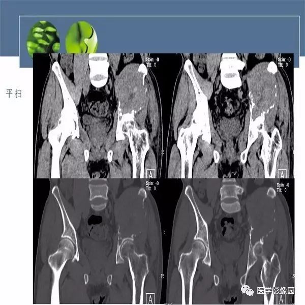 【病例】左侧髂骨浆细胞性骨髓瘤1例CT及MR