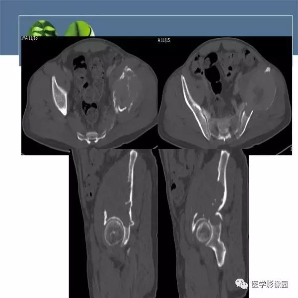【病例】左侧髂骨浆细胞性骨髓瘤1例CT及MR