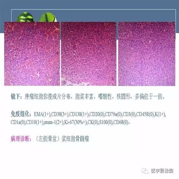 【病例】左侧髂骨浆细胞性骨髓瘤1例CT及MR