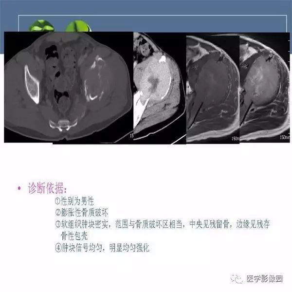 【病例】左侧髂骨浆细胞性骨髓瘤1例CT及MR