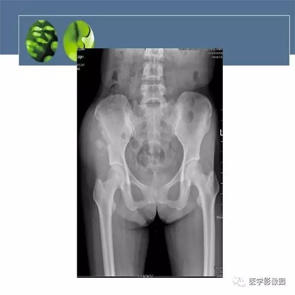 【病例】右侧髂骨甲状腺癌转移瘤1例CT及MR