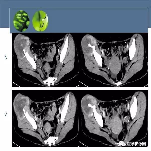 【病例】右侧髂骨甲状腺癌转移瘤1例CT及MR