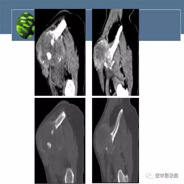 【病例】右侧髂骨甲状腺癌转移瘤1例CT及MR