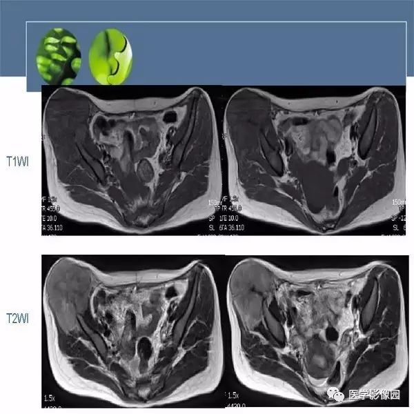 【病例】右侧髂骨甲状腺癌转移瘤1例CT及MR