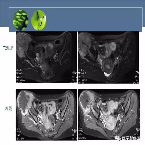 【病例】右侧髂骨甲状腺癌转移瘤1例CT及MR
