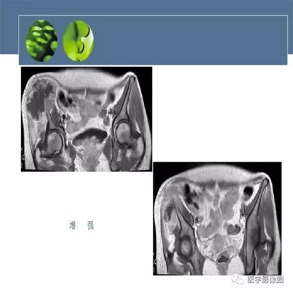 【病例】右侧髂骨甲状腺癌转移瘤1例CT及MR