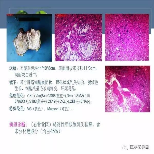 【病例】右侧髂骨甲状腺癌转移瘤1例CT及MR