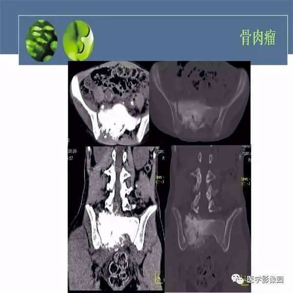 【病例】右侧髂骨甲状腺癌转移瘤1例CT及MR