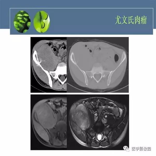 【病例】右侧髂骨甲状腺癌转移瘤1例CT及MR